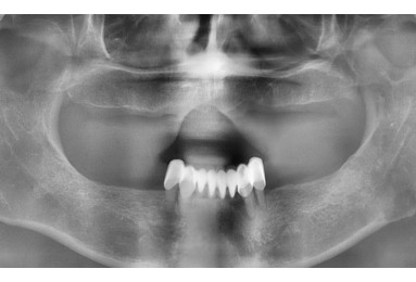 전체 임플란트